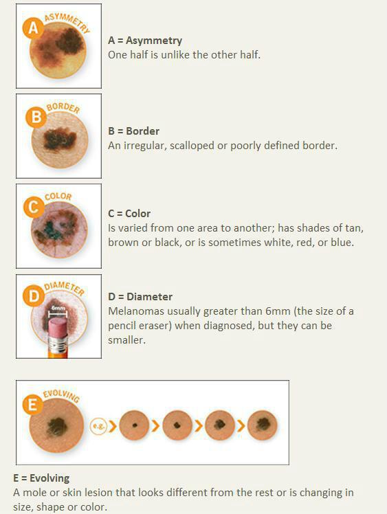 关于检查和识别黑色素瘤您需要了解的信息3