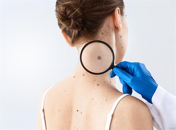 关于检查和识别黑色素瘤您需要了解的信息2