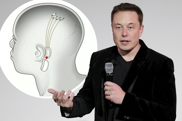 埃隆·马斯克在加拿大的 Neuralink 脑芯片临床试验引发伦理问题1 埃隆·马斯克在加拿大的 Neuralink 脑芯片临床试验引发伦理问题1