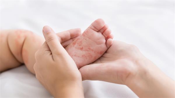 艾伯塔省麻疹病例已接近 2,000 例,一名早产婴儿死于麻疹1 艾伯塔省麻疹病例已接近 2,000 例,一名早产婴儿死于麻疹1